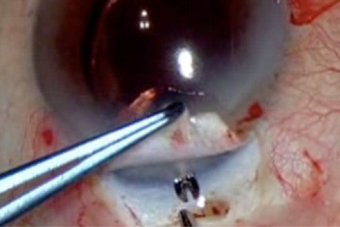 Microcirugía de glaucoma con implante ExPress