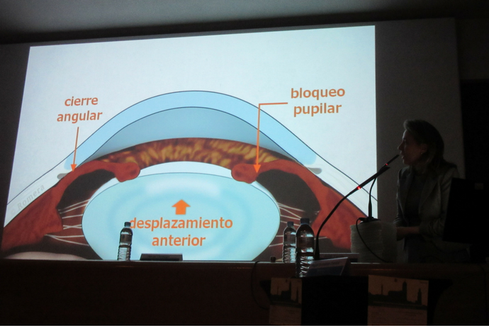 Por qué es tan importante conocer los síntomas del glaucoma por cierre angular primario (GCAP)