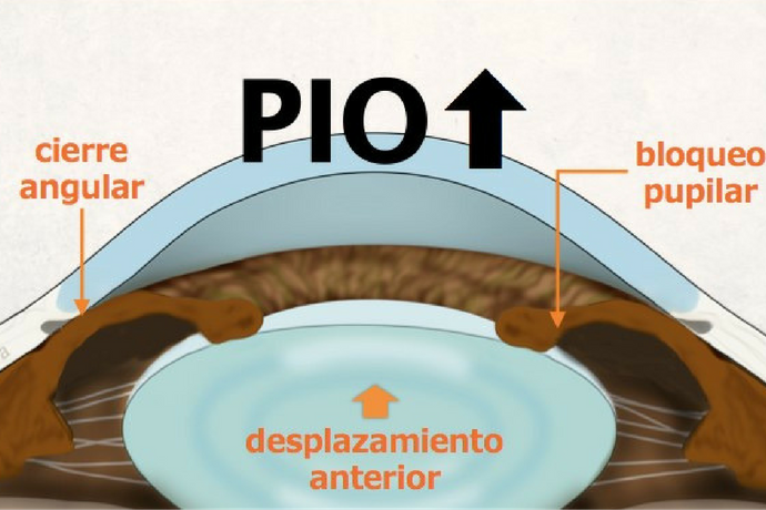 Por qué es tan importante conocer los síntomas del glaucoma por cierre angular primario (GCAP)